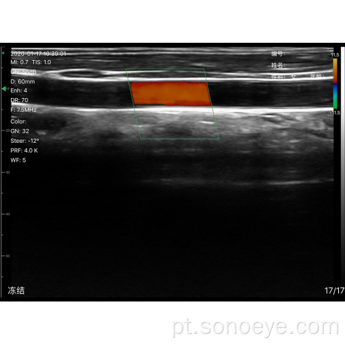 Scanner de ultra-som linear super largura para inspecionar mama